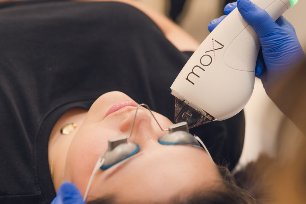 A patient lies down as we use the Moxi laser for acne scar removal in Las Vegas on her face.